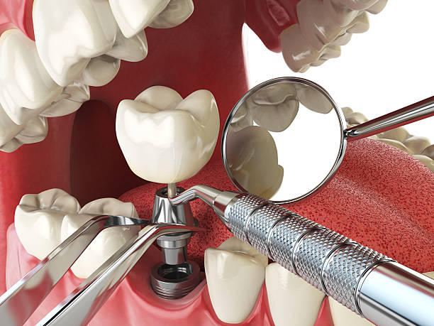 Best Emergency Dentist for Lost Fillings or Crowns in Lake Bluff, IL